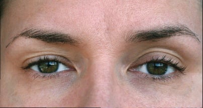 blog-featured-ptosis
