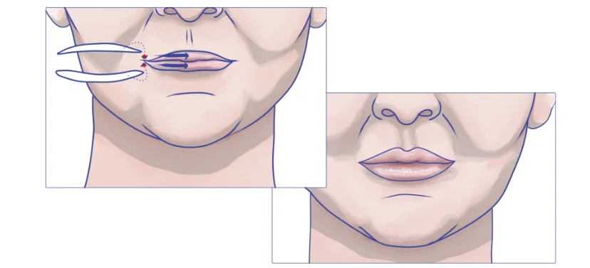 lips implants