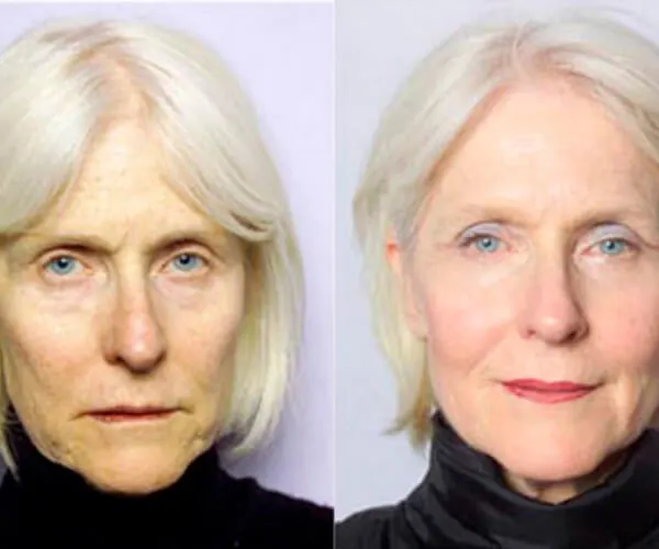 Revanesse® Versa vs Juvederm® Ultra