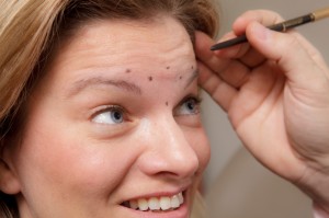Botox® Training Marks on Forehead Example