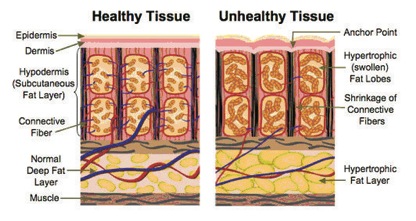 Physiology of Cellulite