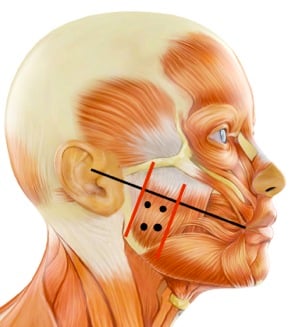 Bruxism Injection Chart