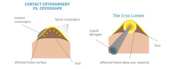 Cryosurgery