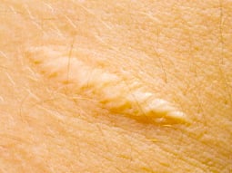 Keloid Scar