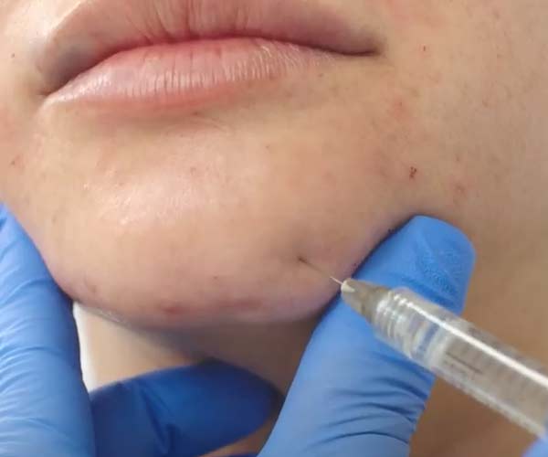 Sculptra® Injections: What You Need to Know