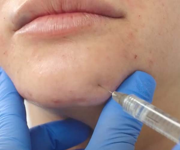 What Are the Top Dermal Filler Brands?