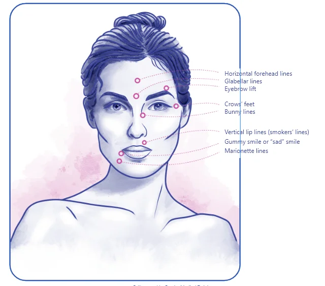 face areas to inject botox