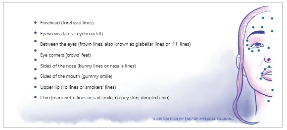 botox site diagram