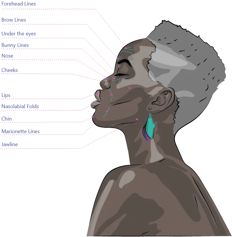 areas to inject dermal fillers