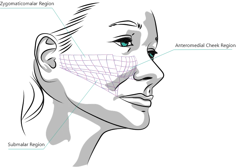 juvederm - areas to inject