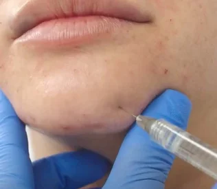 dermal-fillers