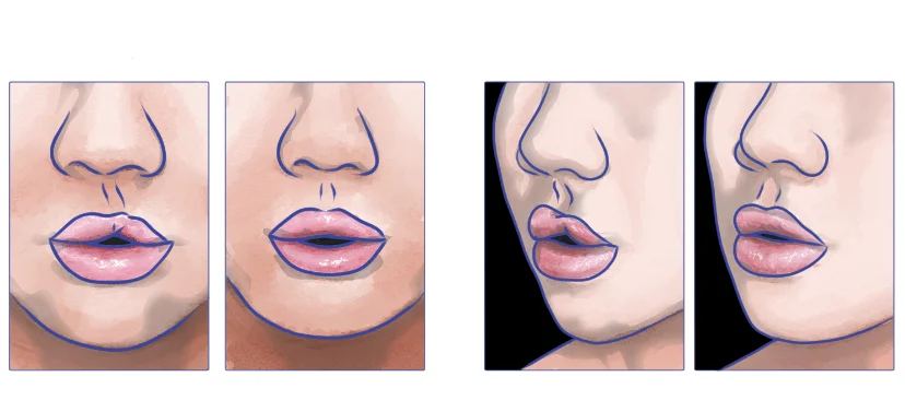 lip injections side effects
