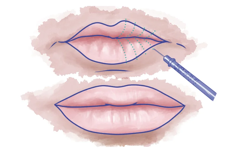 types of lip injections