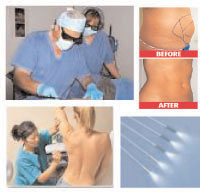 Laser Liposuction Training