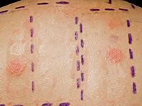 Allergy Dermal Skin Test Allergy Dermal Skin Test