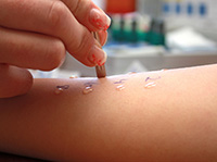 Skin Prick Testing Skin Prick Testing
