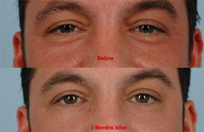 Laser Blepharoplasty Training