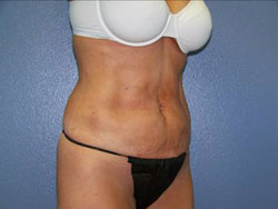 liposuction after