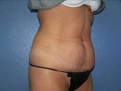 liposuction before