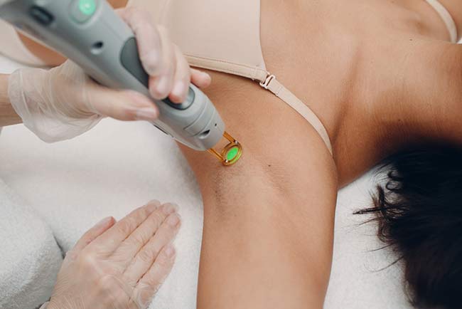 cosmetic laser armpit