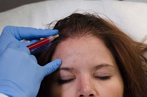 Hands-on Training of Alopecia Treatment utilizing Platelet Rich Plasma
