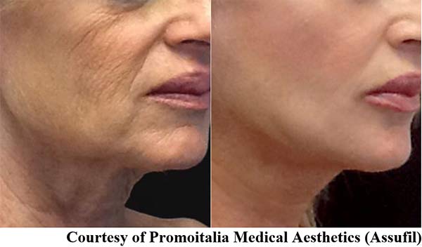 Before | After Photo of PDO Thread Lift Procedure