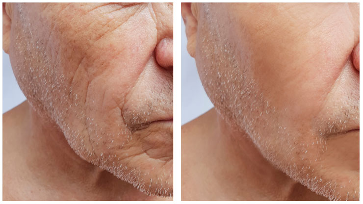 collagen boosting training cheeks