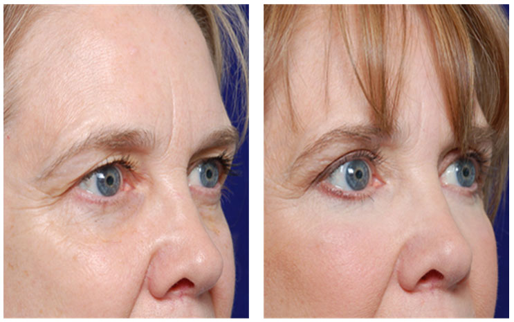 collagen boosting training - eyes area