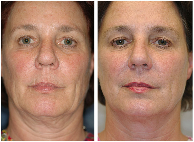 collagen boosting training - face