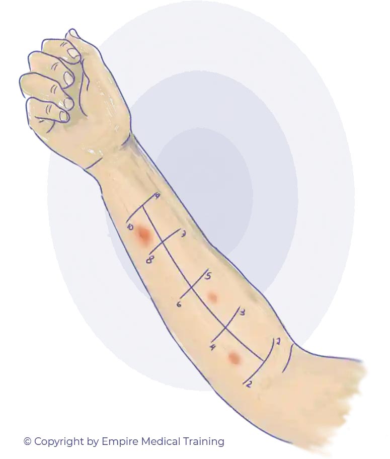 Allergy Training Test on the Arm