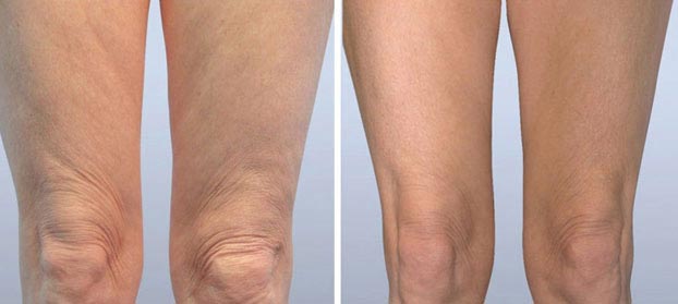 Body Contouring Legs Training Before and After