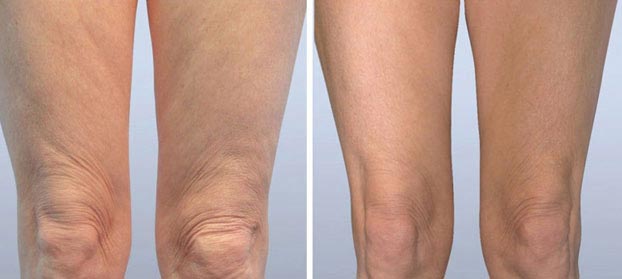Body Contouring Legs Training Before and After