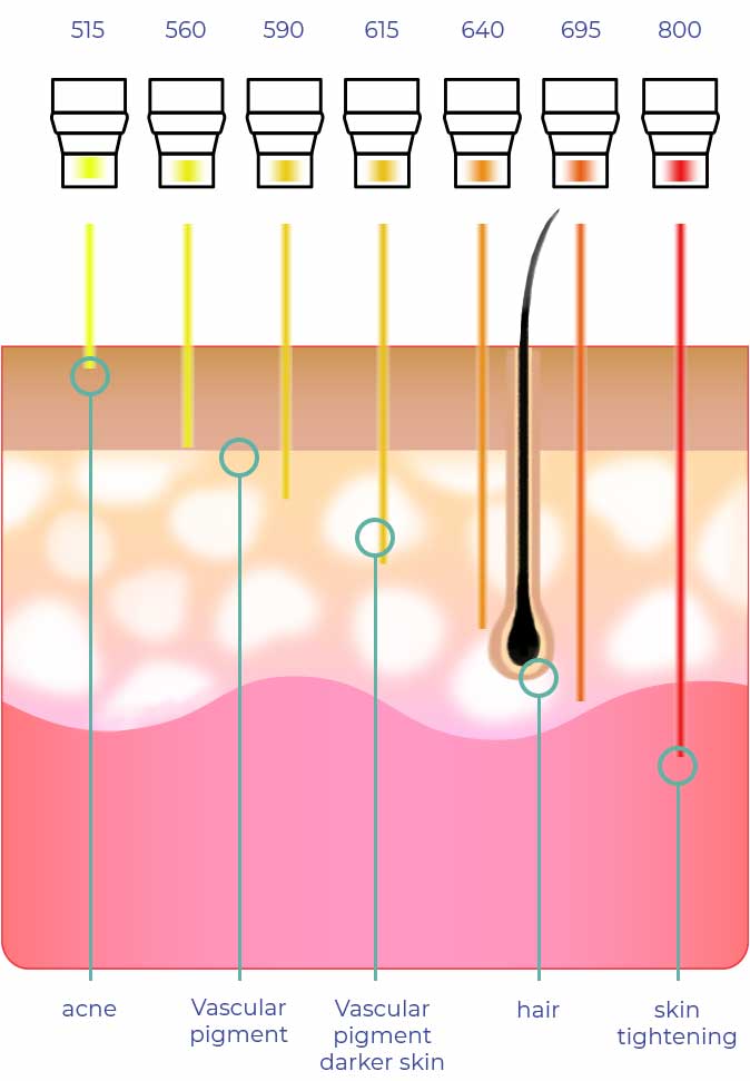 Intense Pulse Light Cosmetic Laser