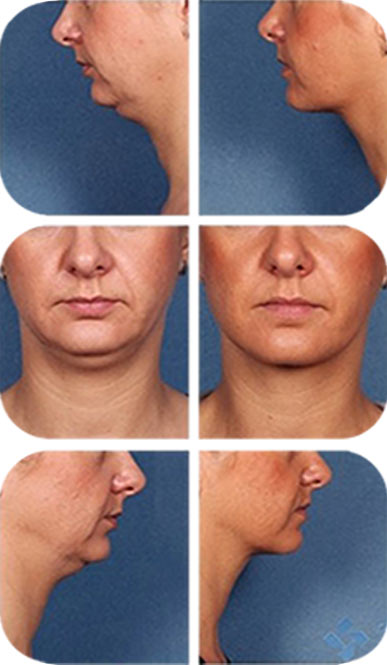 Kybella Injection Results Before & After