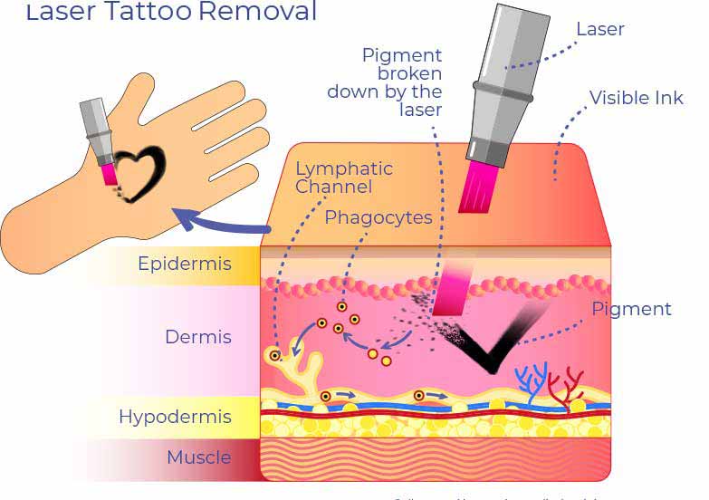 Laser Tattoo Removal