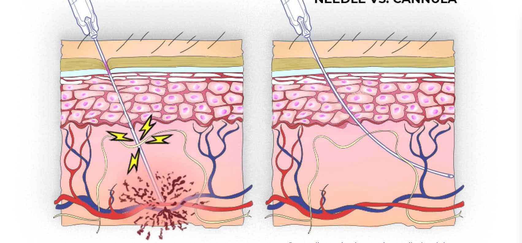 mighty microcannulas Safe and Effective Techniques Using Microcannulas in Aesthetics