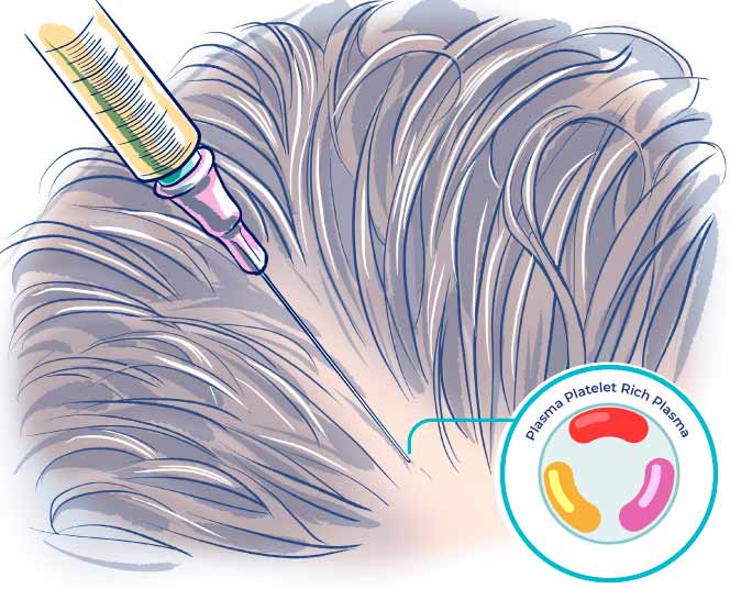 pdo-threads-scalp-insertion