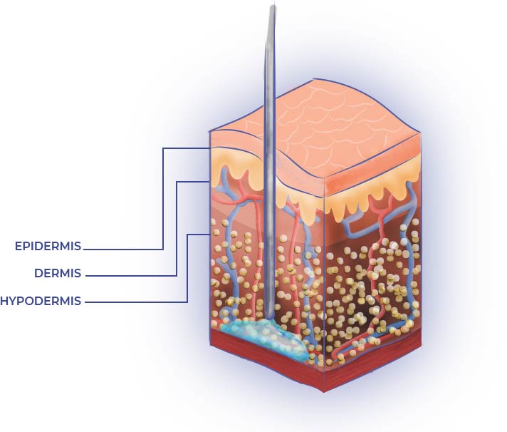 Tumescent Liposuction Fat Layer Fluid