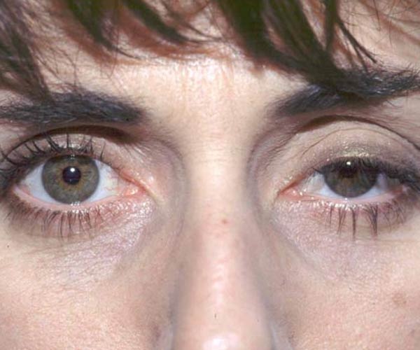 Ptosis: What It Is and How to Treat It