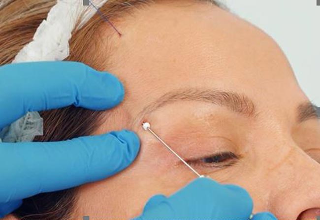 Aesthetics - injections around the eyes