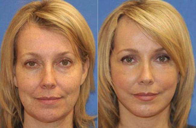 Aesthetics - injections around the eyes - before and after