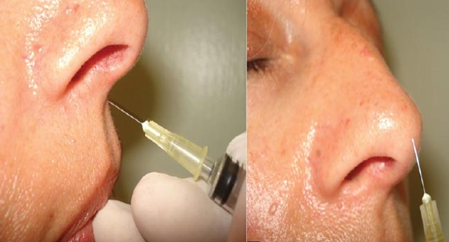 Aesthetics - nose injections