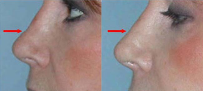 Aesthetics - nose injections