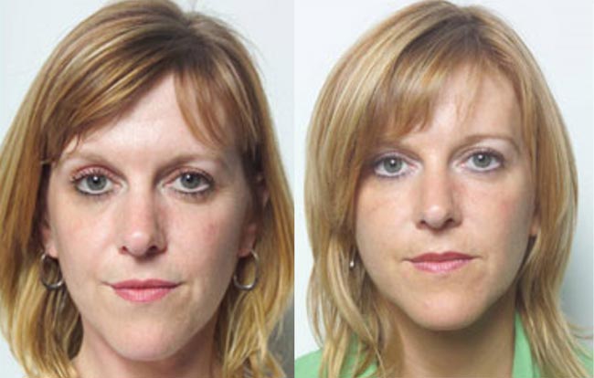 sculptra before and after