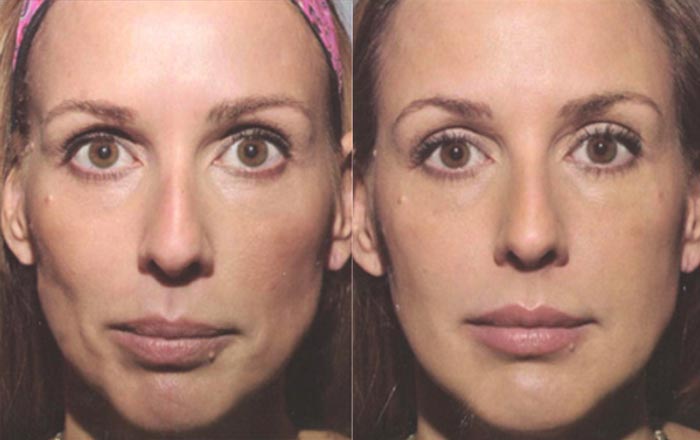 sculptra before and after