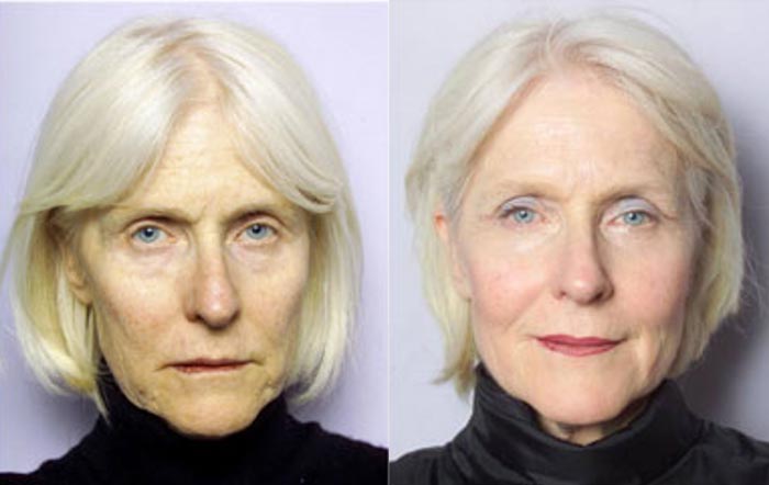 sculptra before and after