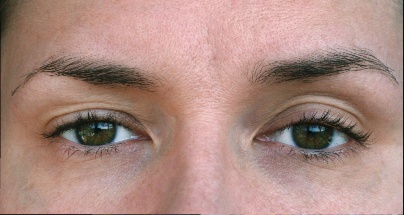 blog-featured-ptosis