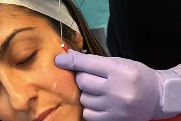 fall sale thread lift training