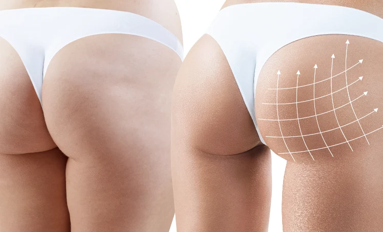 the-perfect-butt-injectable-services-course-highlights