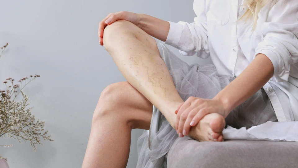 Sclerotherapy for Physicians & Nurses Picture